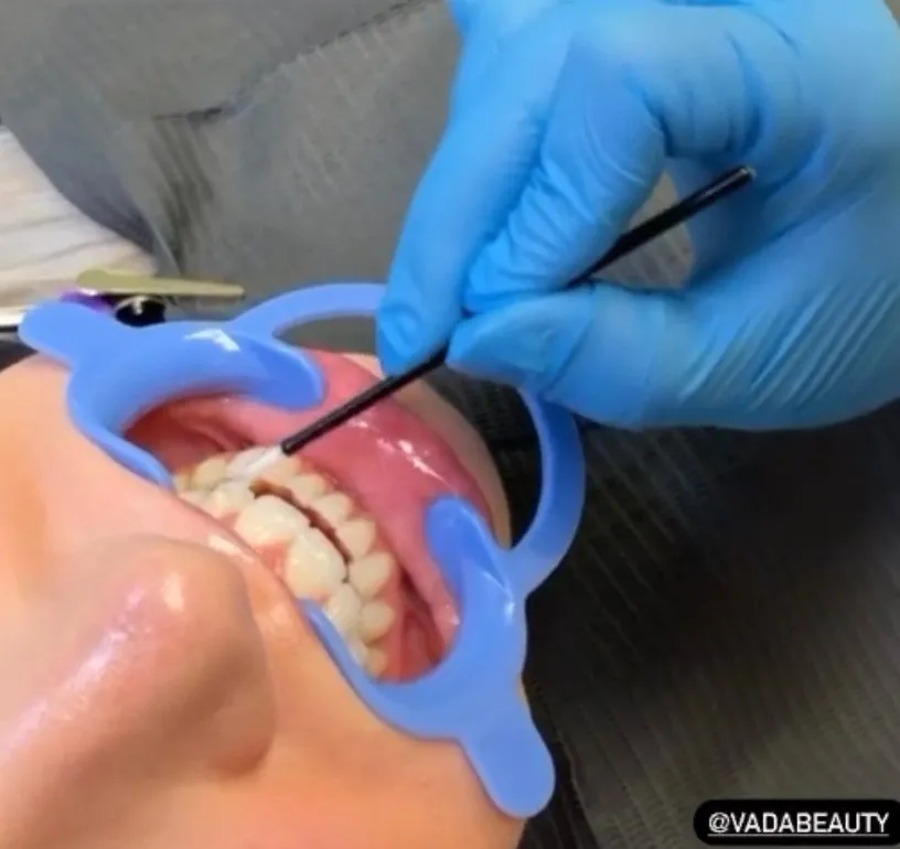 26798 teeth whitening procedure overview