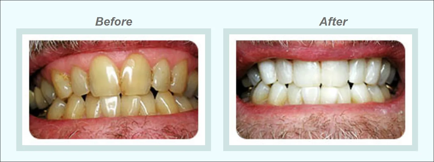 26798 understanding teeth discoloration