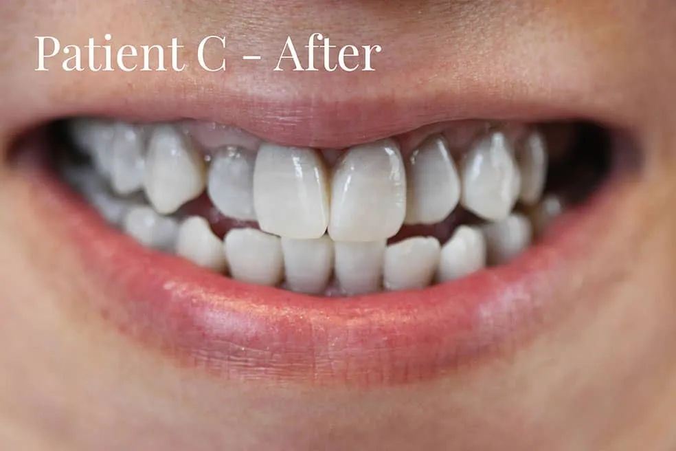26799 kor whitening before after