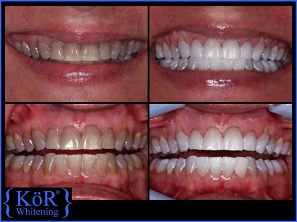 26799 kor whitening consultation