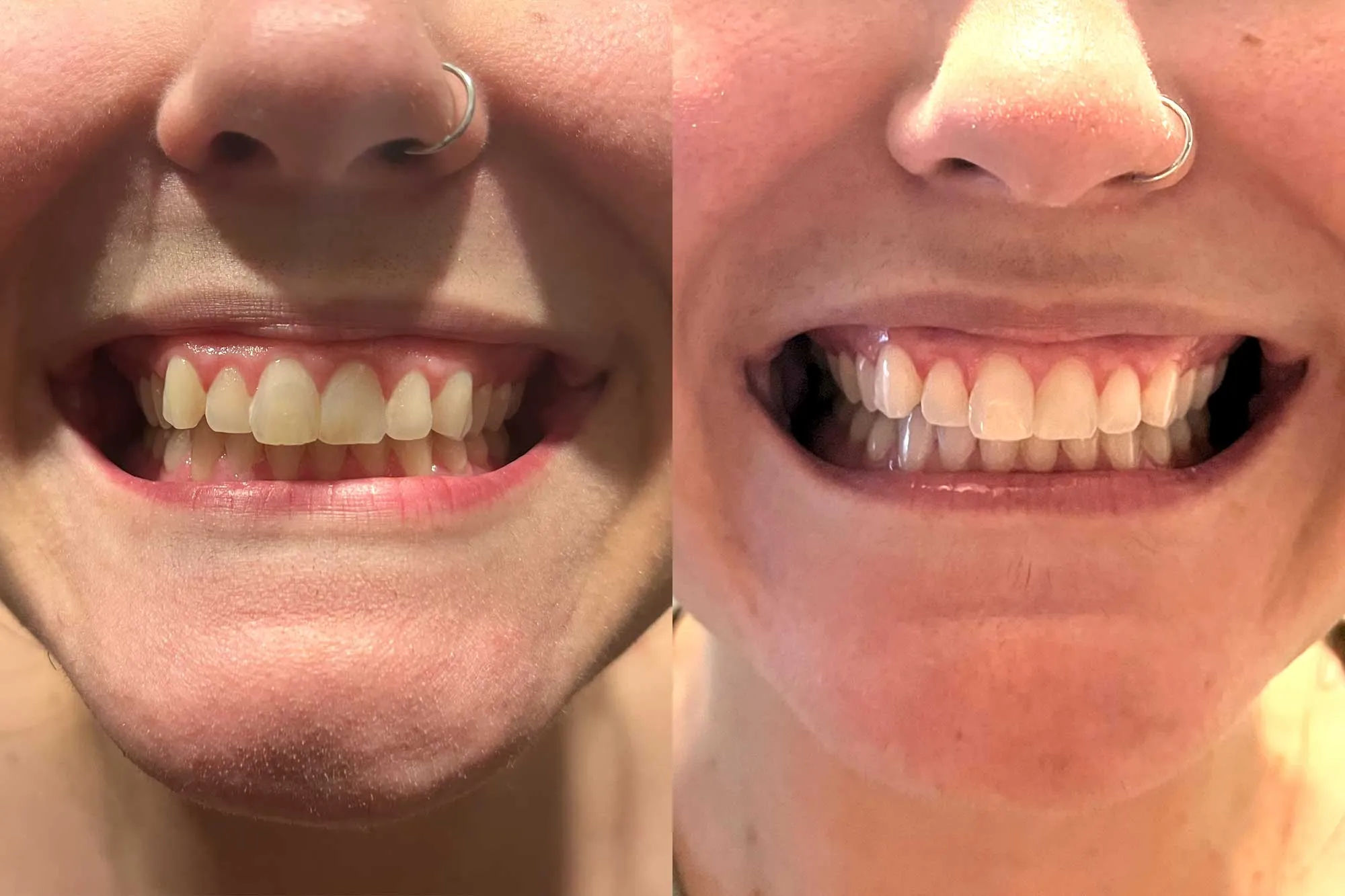 26799 kor whitening smile