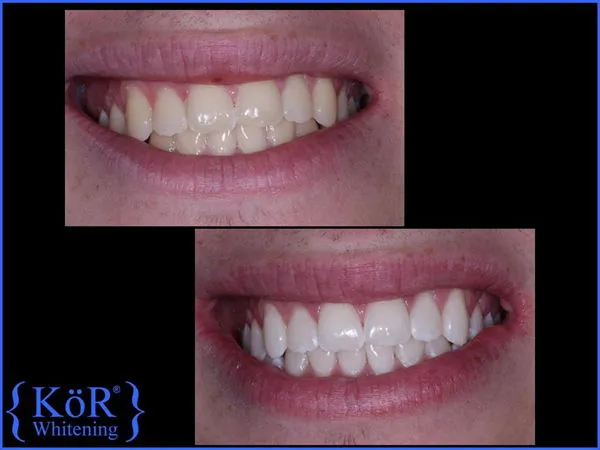 26799 kor whitening trays