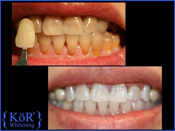 26799 kor whitening treatment
