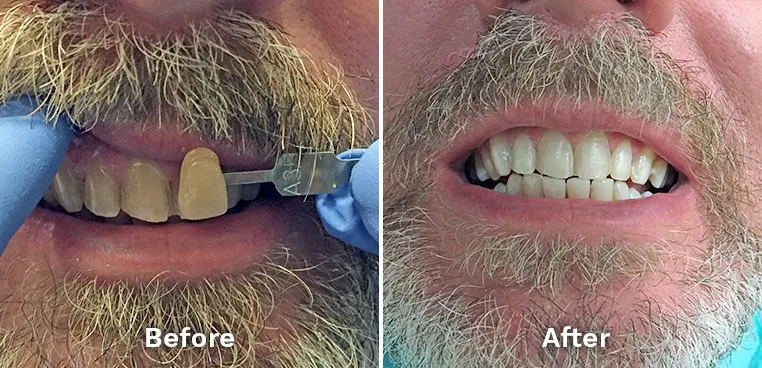 26801 in office teeth whitening