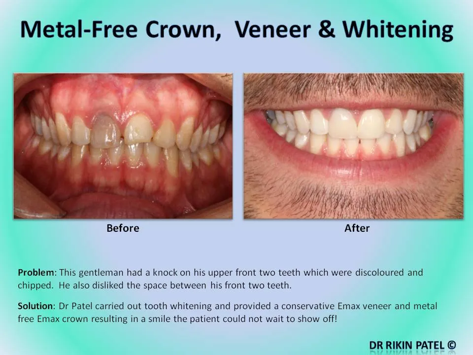 26806 veneers procedure