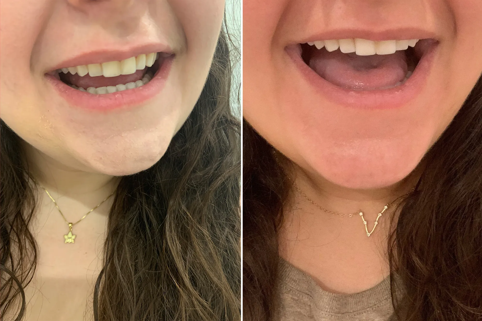 /img/26810-teeth-whitening-maintenance.webp