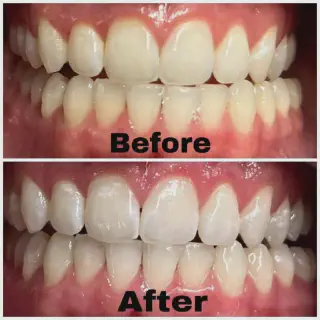 /img/26811-teeth-whitening-edina-mn-healthy-teeth.webp