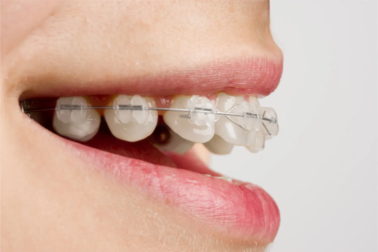 26815 dental veneers