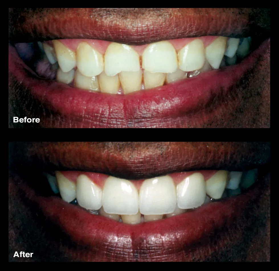 26815 in office teeth whitening