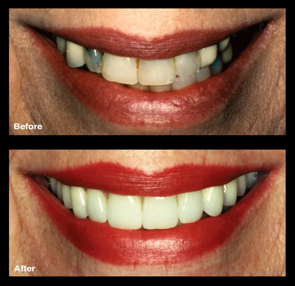26815 teeth whitening options