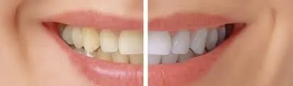 26817 at home teeth whitening kits