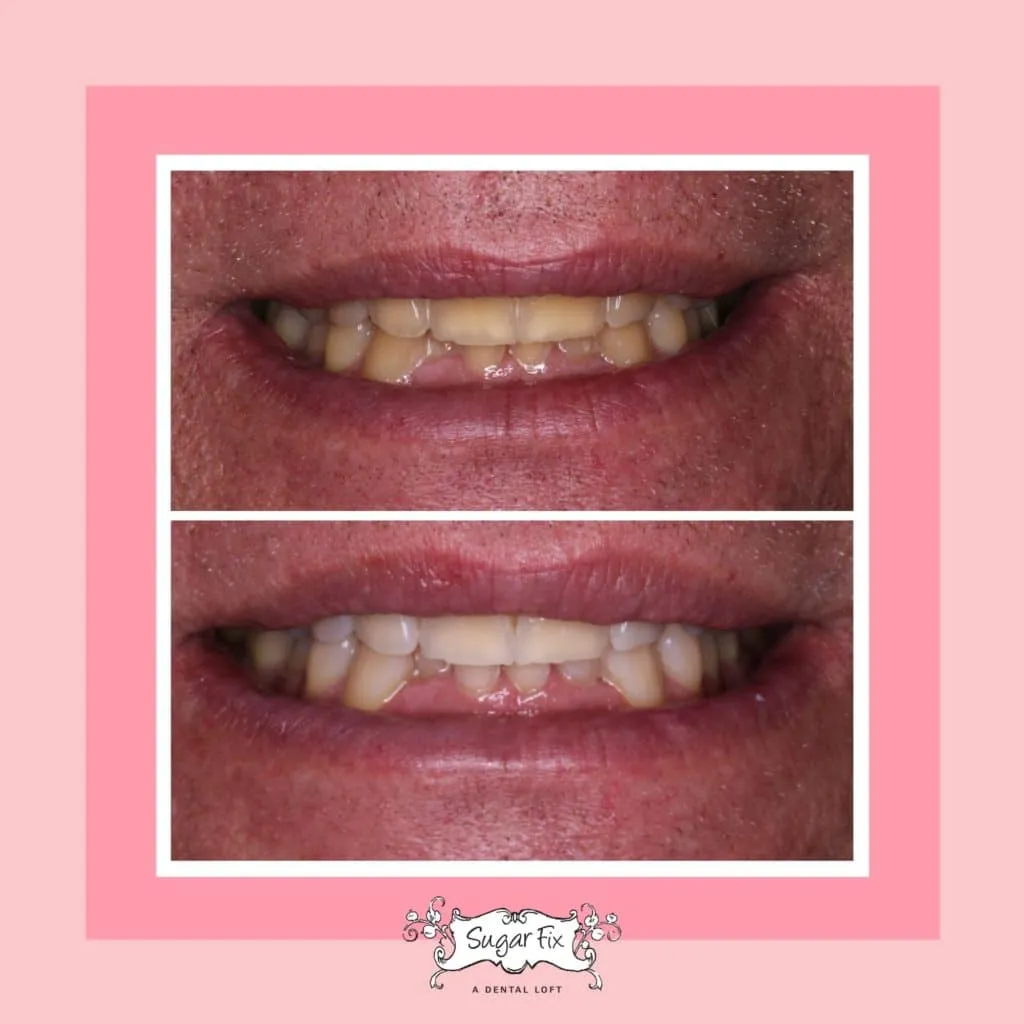 26819 at home teeth whitening