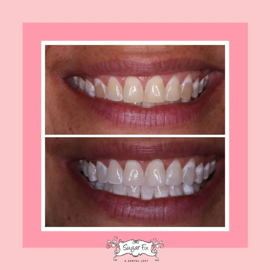 26819 professional teeth whitening