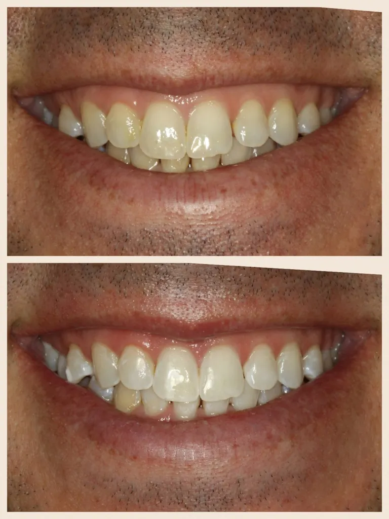 26819 teeth whitening sugar land cost