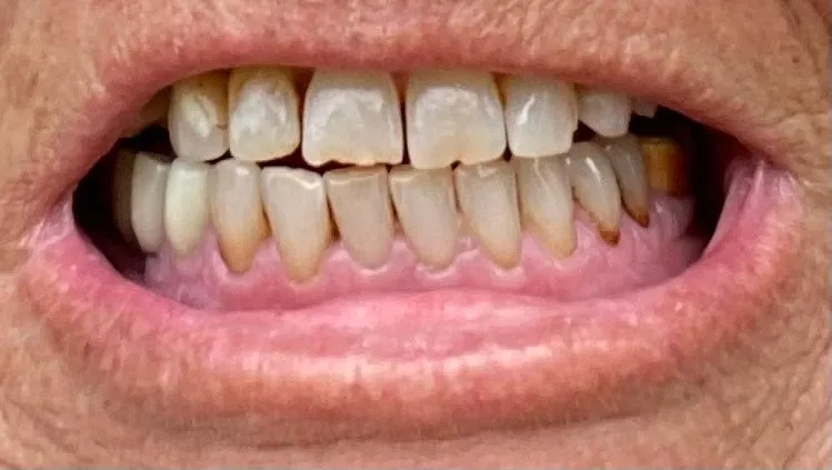 26830 snow teeth whitening wand 2