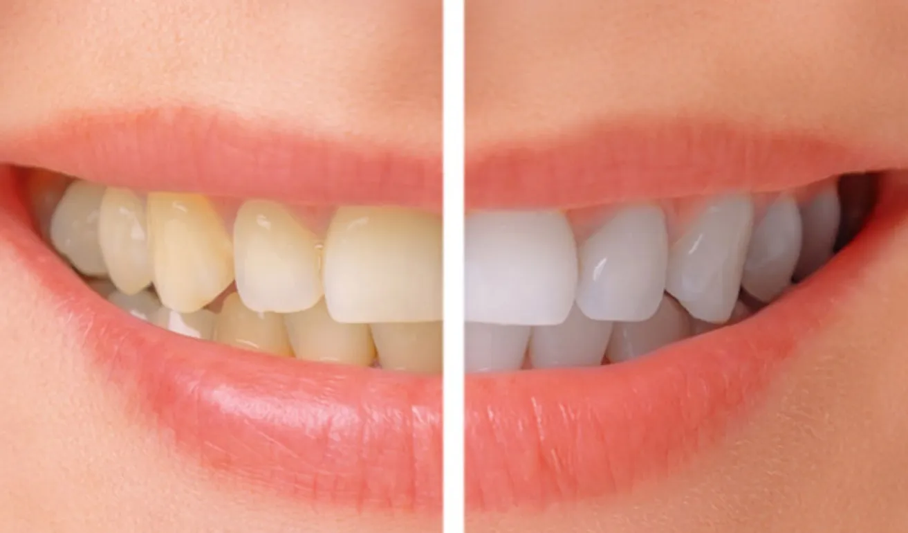 /img/26832-teeth-whitening-alternatives.webp