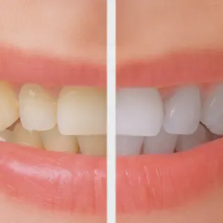 /img/26832-teeth-whitening-alternatives.webp