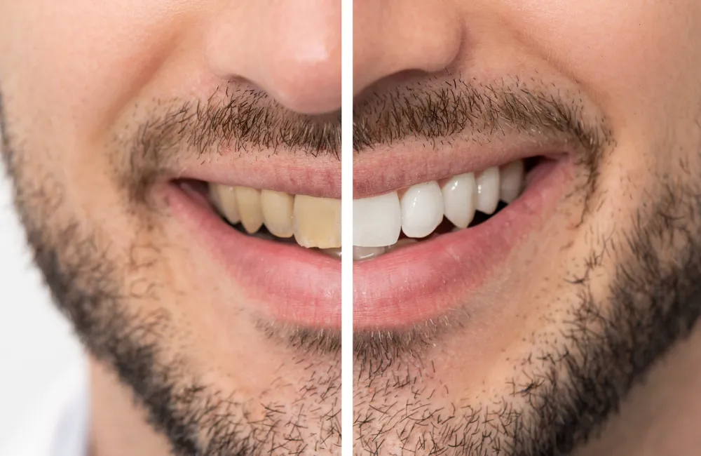26832 teeth whitening procedure