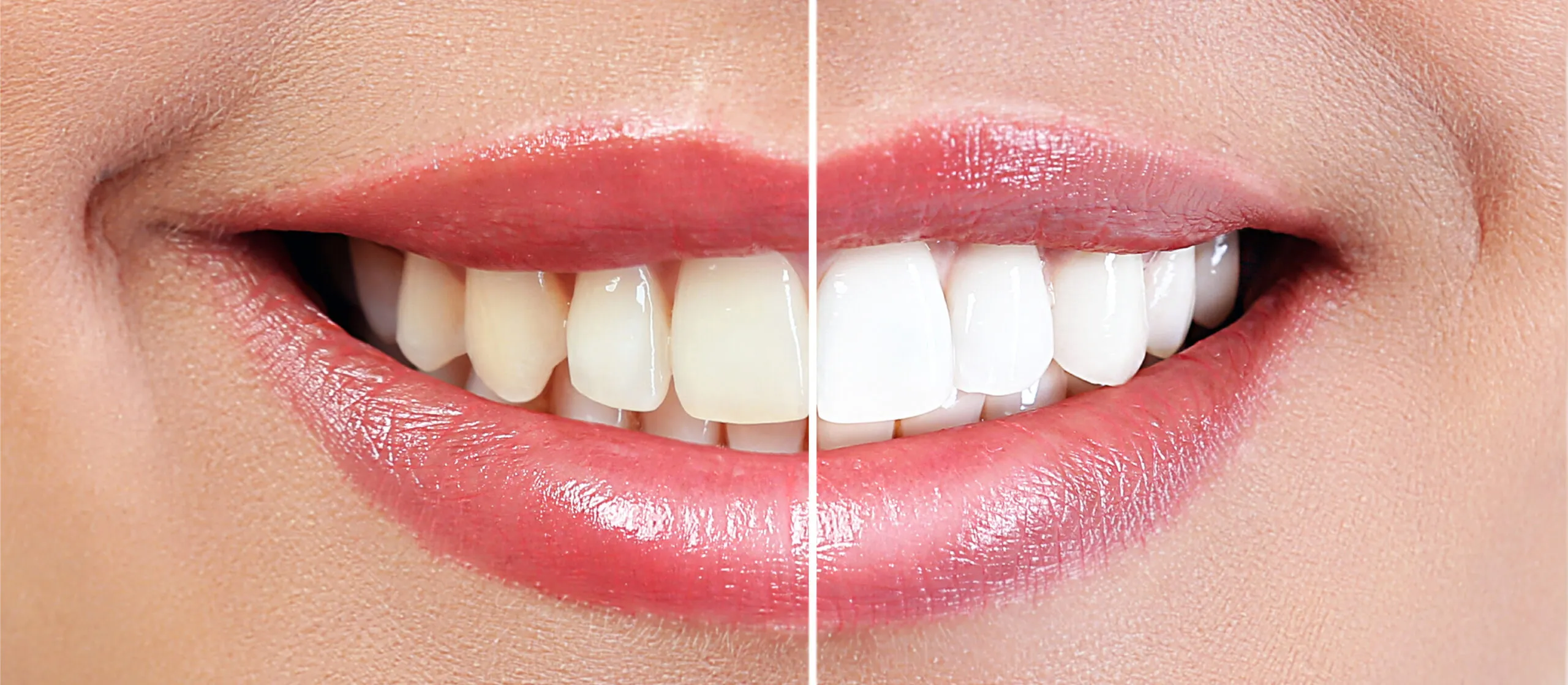 26832 uneven whitening