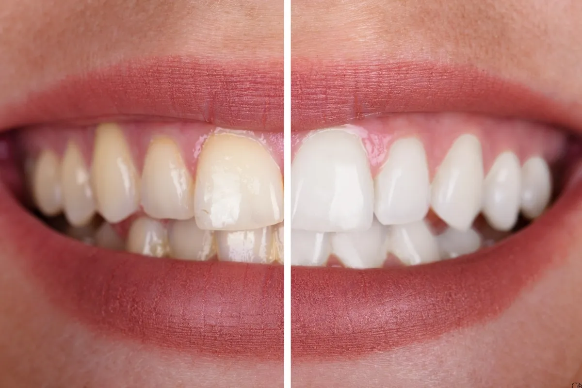 26839 choosing teeth whitening provider