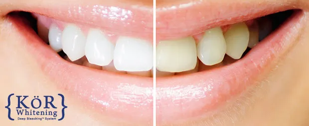 26843 at home teeth whitening kits
