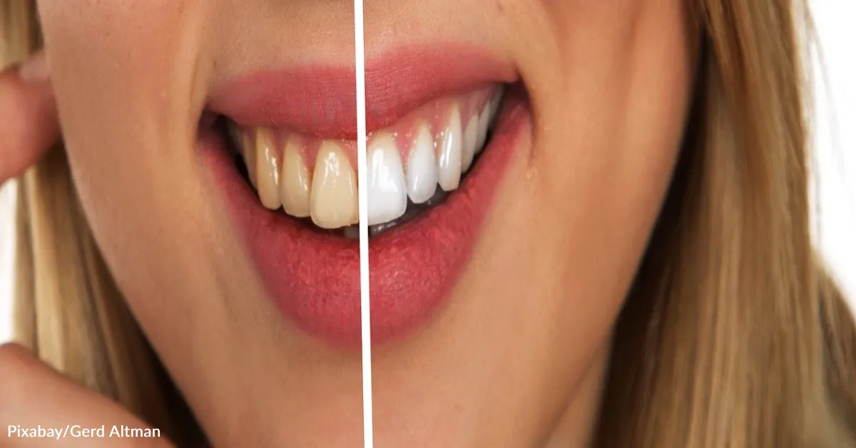 26844 tooth enamel erosion