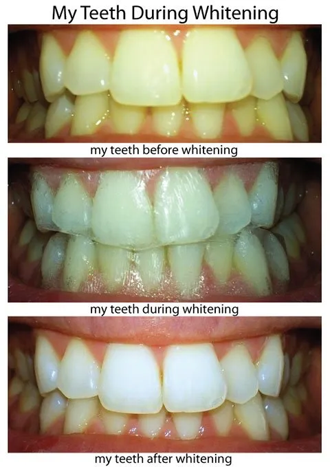 26845 teeth whitening before after 1