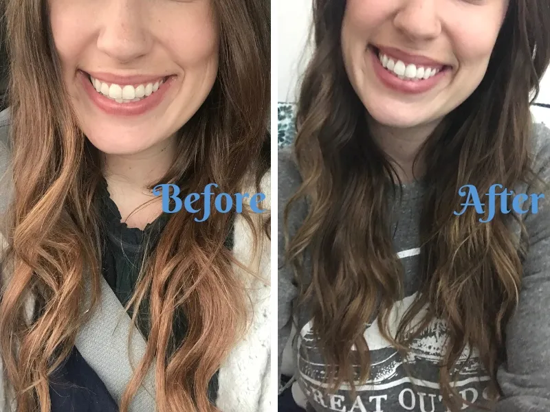 26845 teeth whitening before after 2