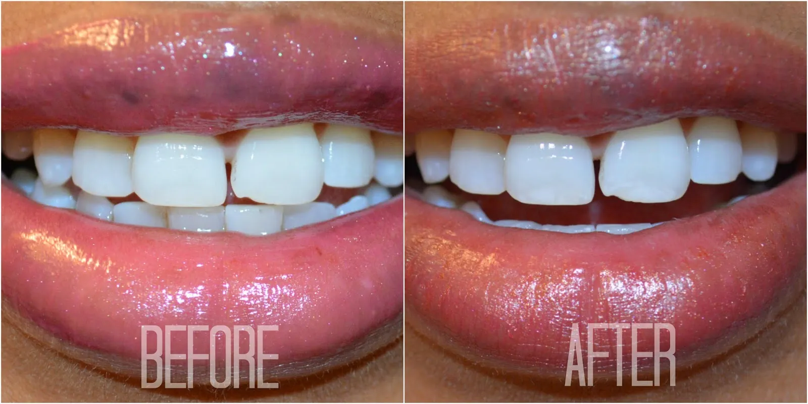 26845 teeth whitening before after 3