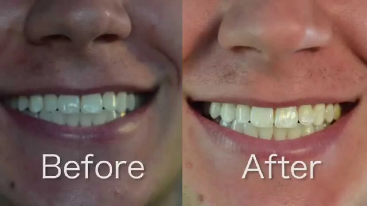 26845 teeth whitening sensitive