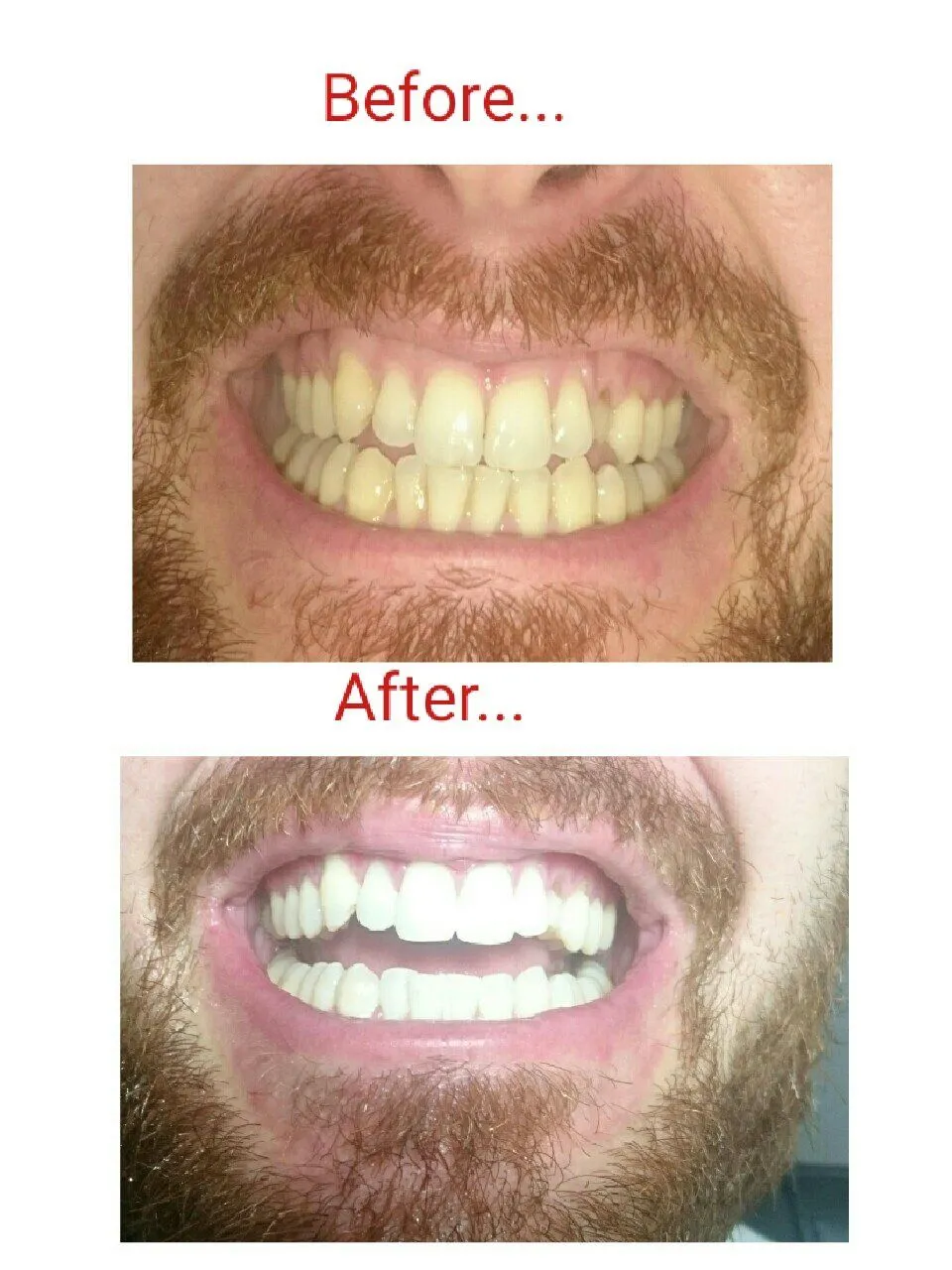 26846 over the counter whitening