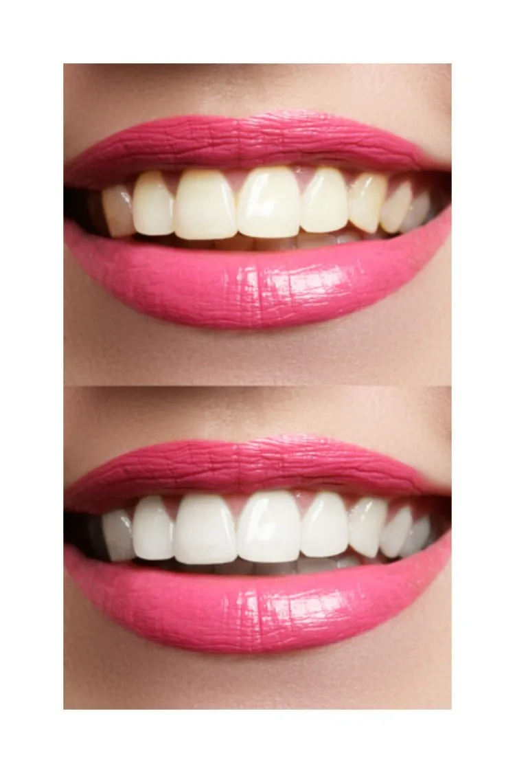 /img/26846-teeth-whitening-maintenance.webp