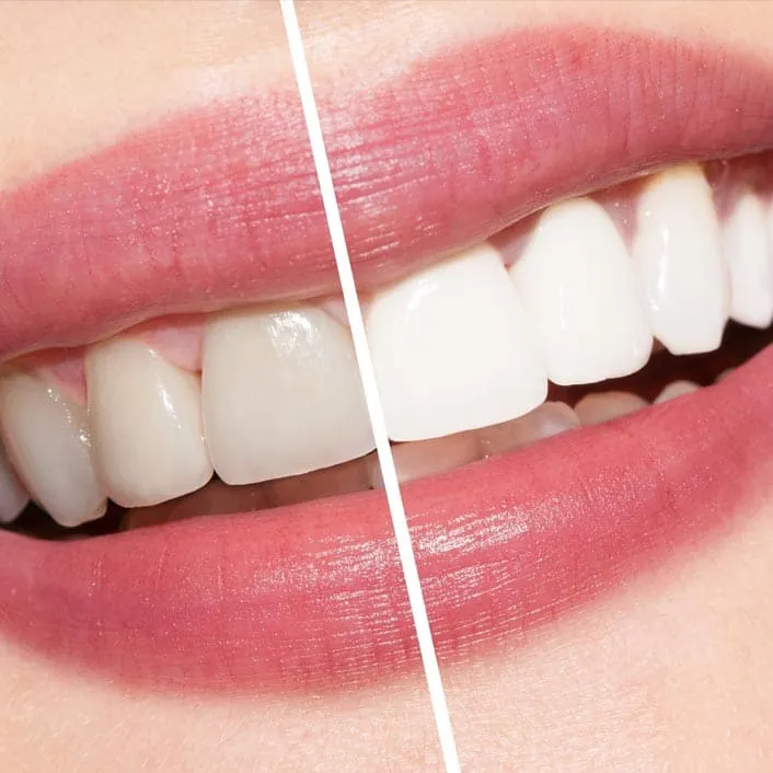 26847 at home teeth whitening products