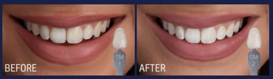 26847 teeth whitening maintenance