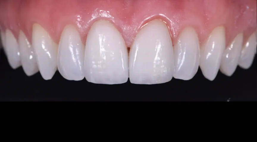 26848 dental veneers