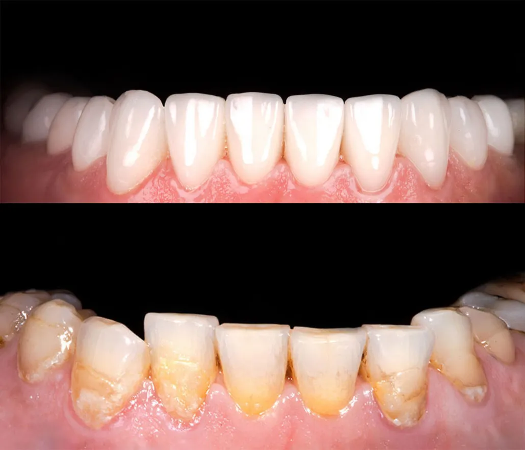 26848 teeth stains crowns veneers