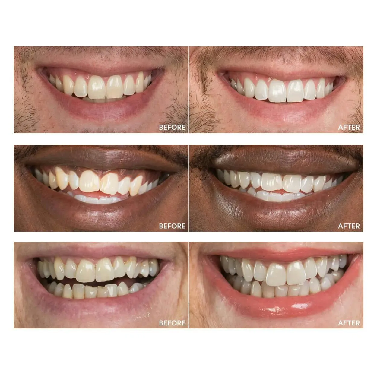 26852 teeth whitening gel expiration