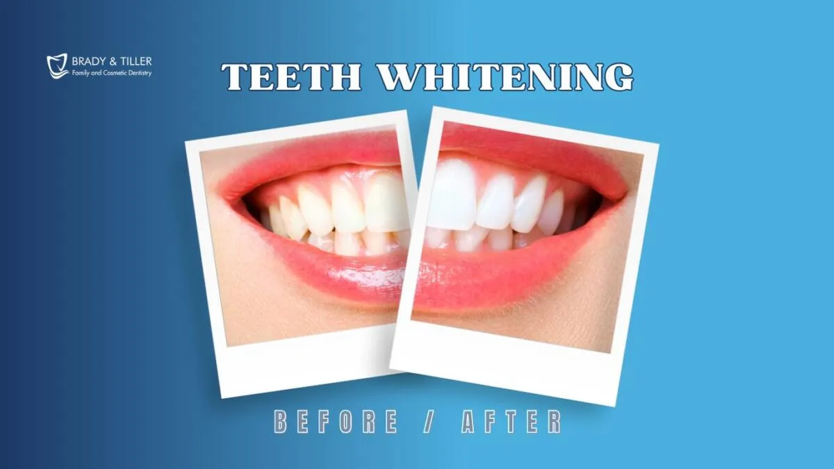 26857 teeth whitening trays