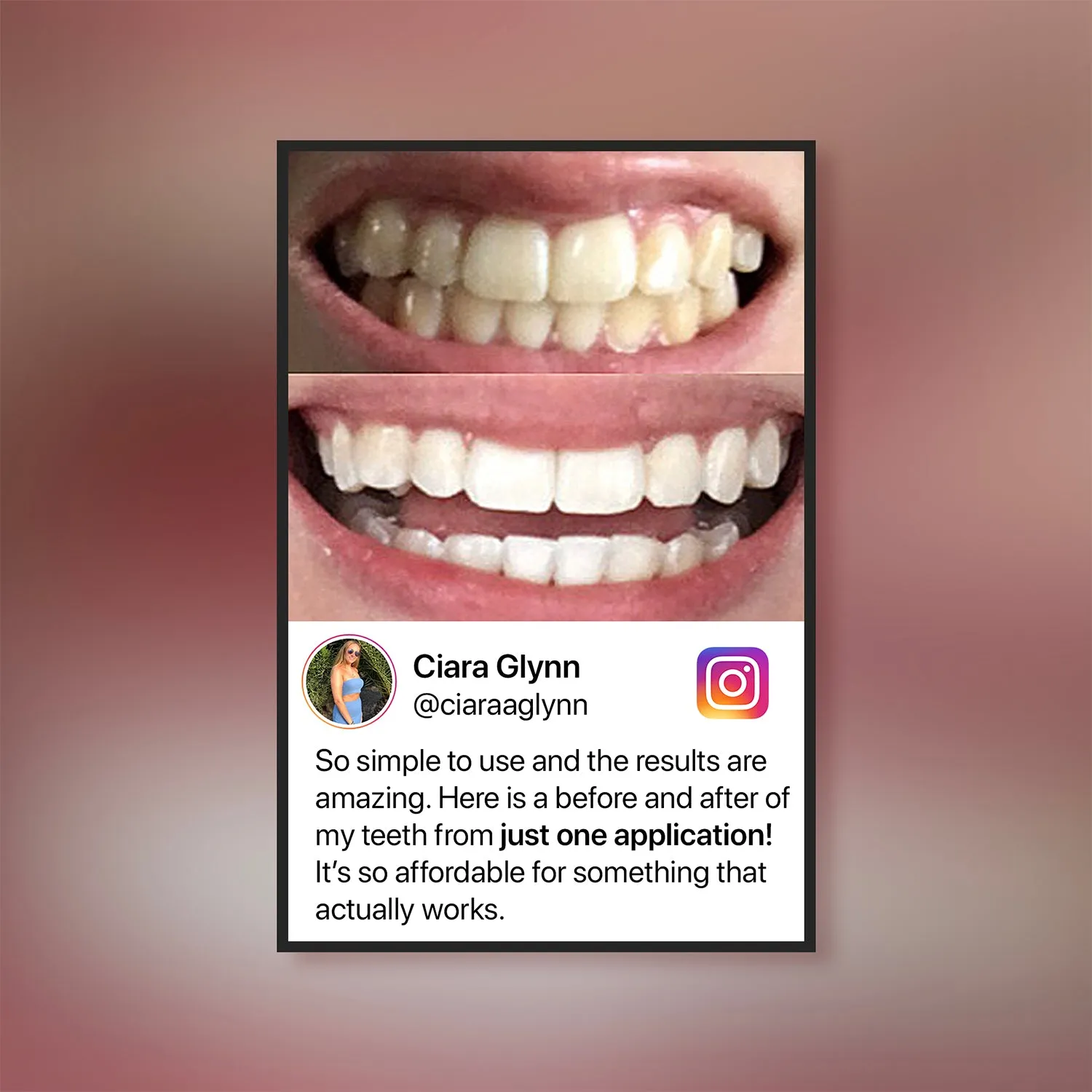 26860 teeth whitening aftercare