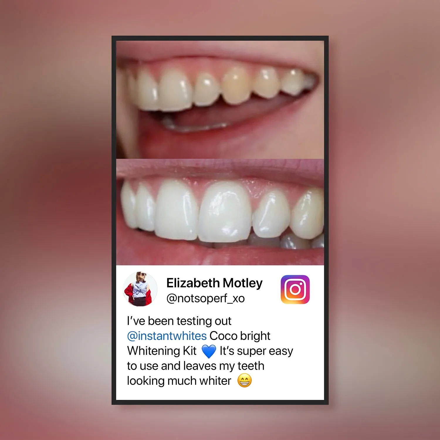 26860 teeth whitening application process
