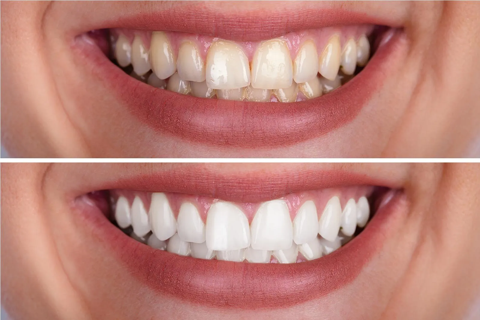 26864 oral hygiene whitening