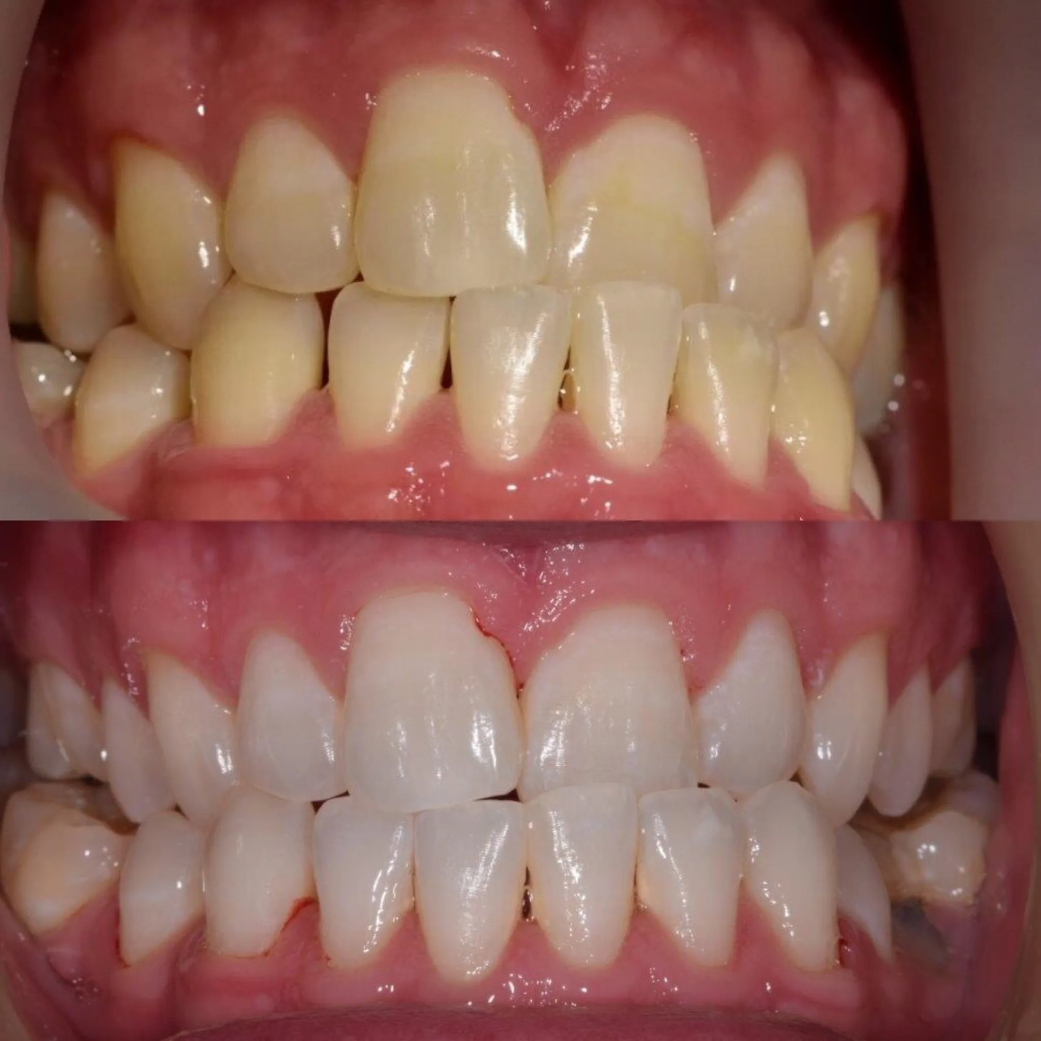 26864 teeth whitening diet