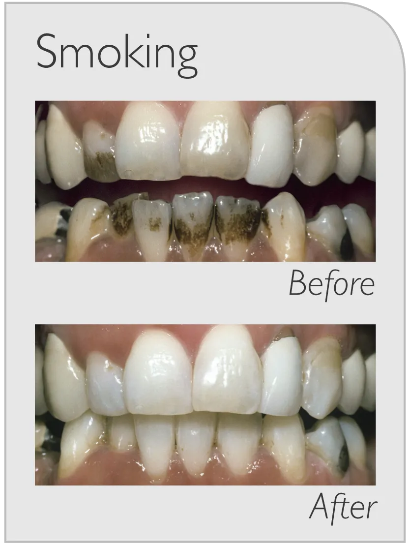 /img/26865-whitening-trays-usage.webp