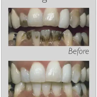 /img/26865-whitening-trays-usage.webp