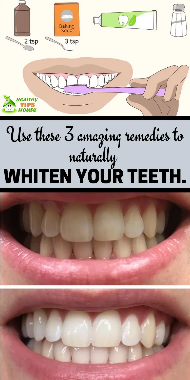 26866 foil teeth whitening application