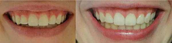 26867 teeth whitening alternatives