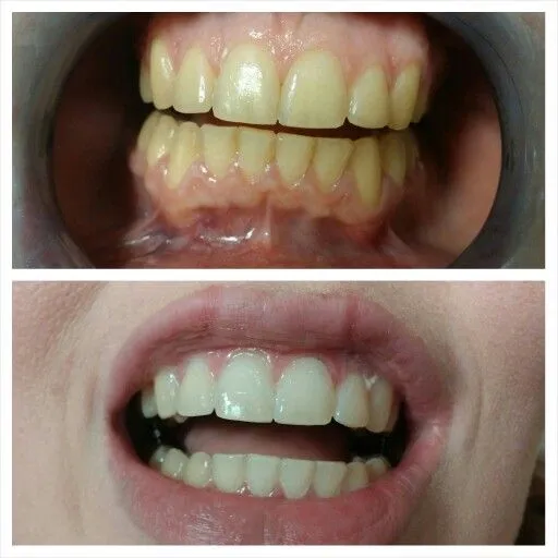 26873 home remedies teeth whitening