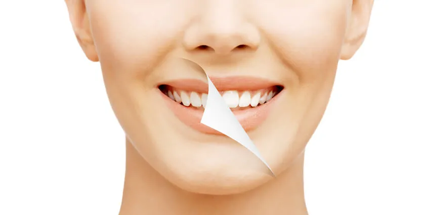 26873 professional teeth whitening