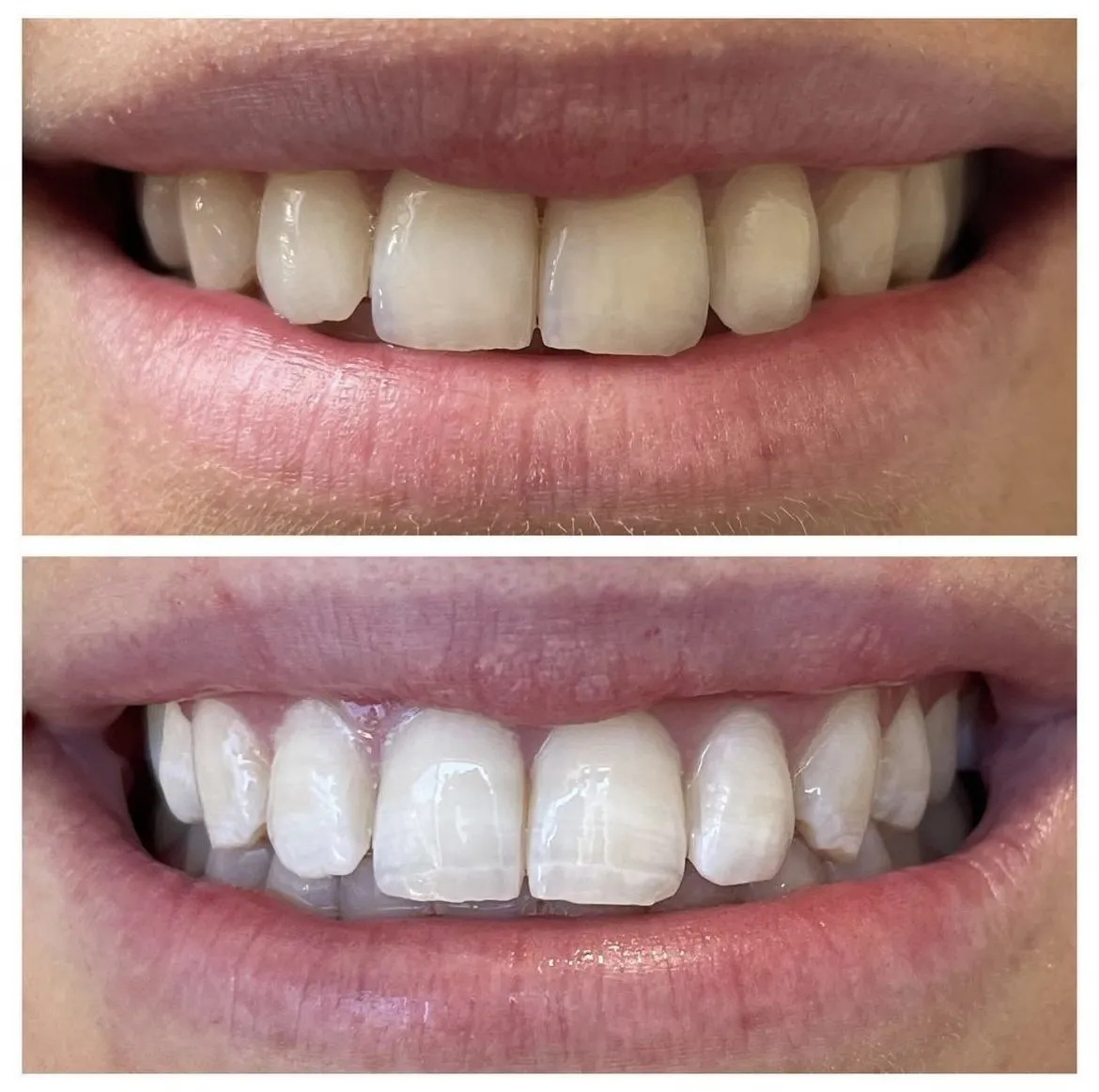 26873 teeth whitening confidence