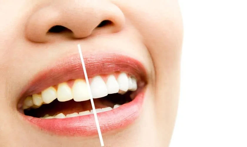 26877 applying white smile mousse
